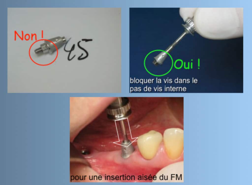 Figure 15 : insertion d'un pilier traditionnel