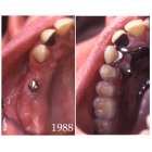 Prothèse amovible partielle : apport de l’implantologie