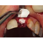 Remplacement d’une incisive maxillaire après greffe particulaire autogène