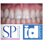 Réhabilitation pluridisciplinaire du sourire dans le cas d’une canine maxillaire ankylosée