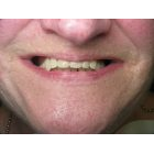 Éliminer le syndrome de combinaison par une restauration implantaire fixe au maxillaire