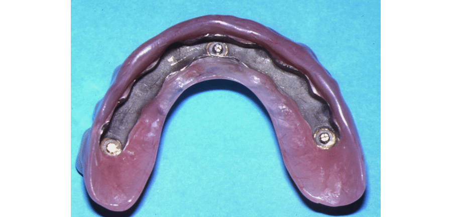 Barre fraisée sur implants au maxillaire : l’option adaptée au bruxisme