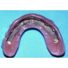 Barre fraisée sur implants au maxillaire : l’option adaptée au bruxisme