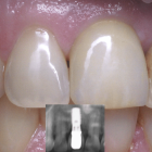 Maitriser les difficultés du secteur incisivo-canin lors d’un traitement implantaire