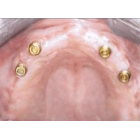 Prothèse complète sur boutons pression au maxillaire ?