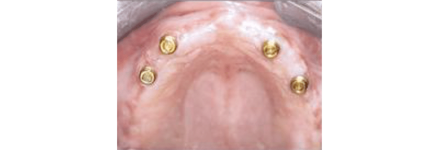 Prothèse complète sur boutons pression au maxillaire ?